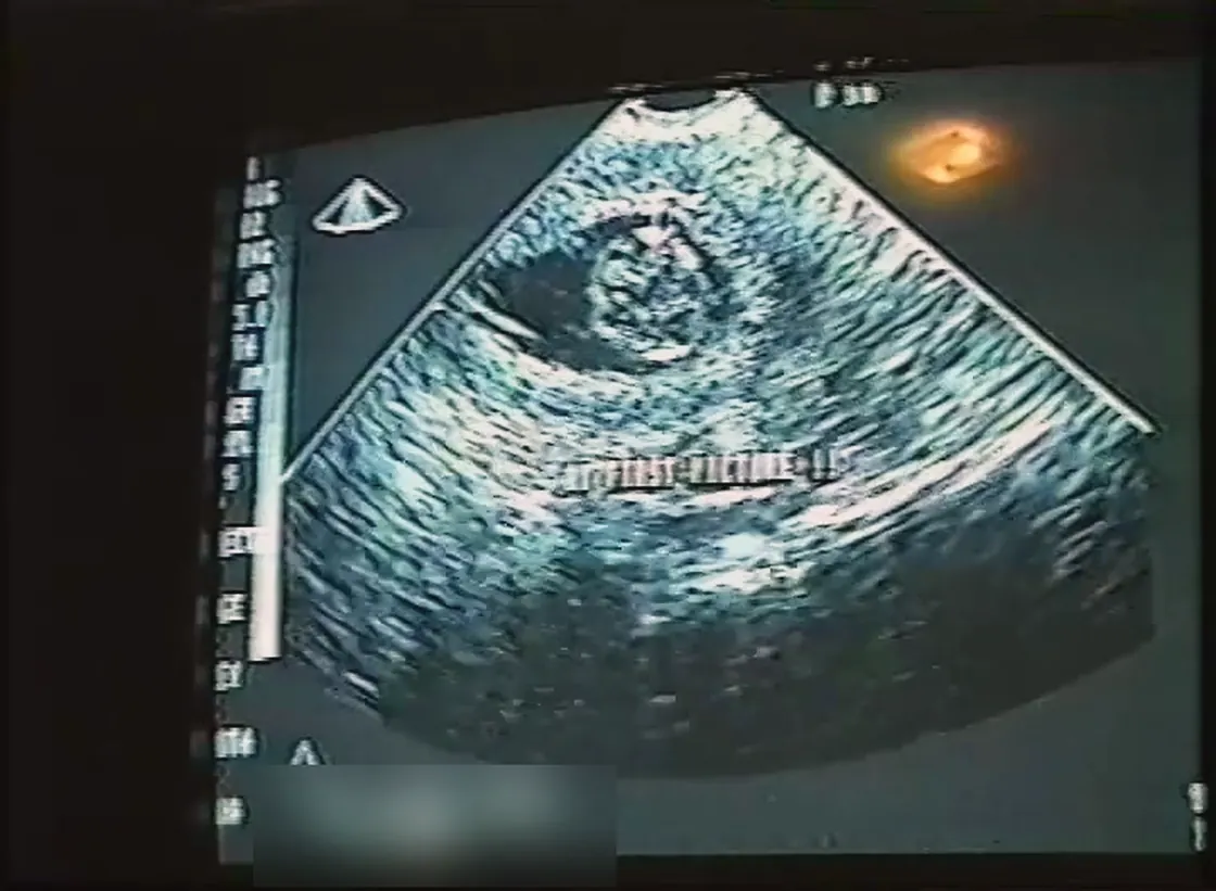 A video frame of an ultrasound on a monitor, grainy and blue-white, with burned-in text along the edges and the patient name and record number obscured.